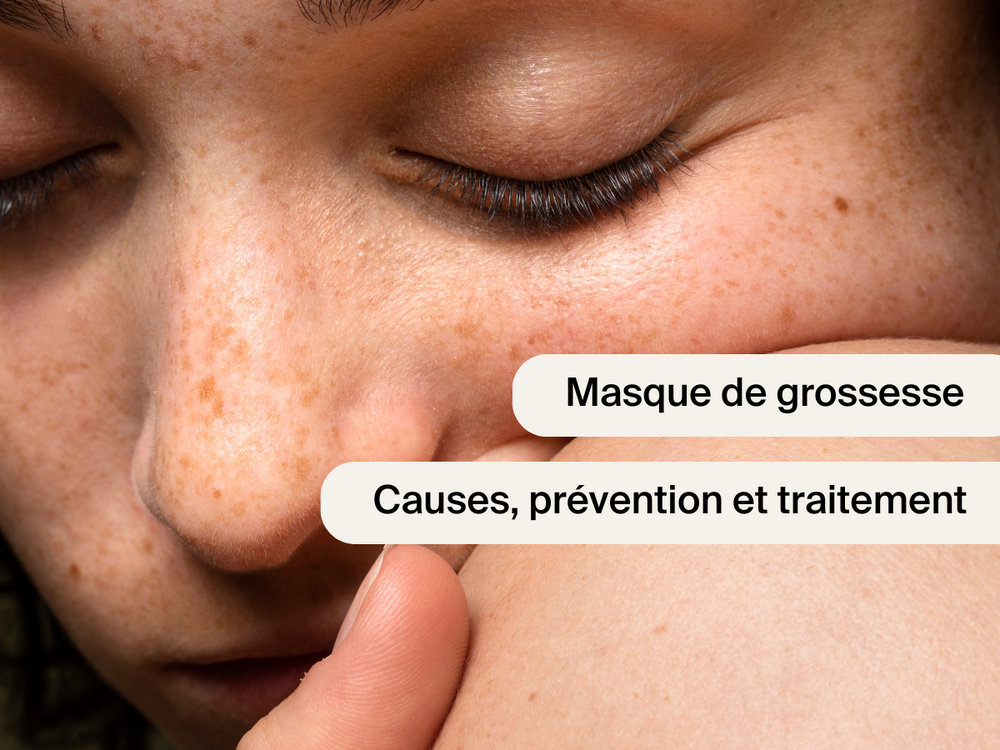 Masque de grossesse visage : causes, prévention et solutions