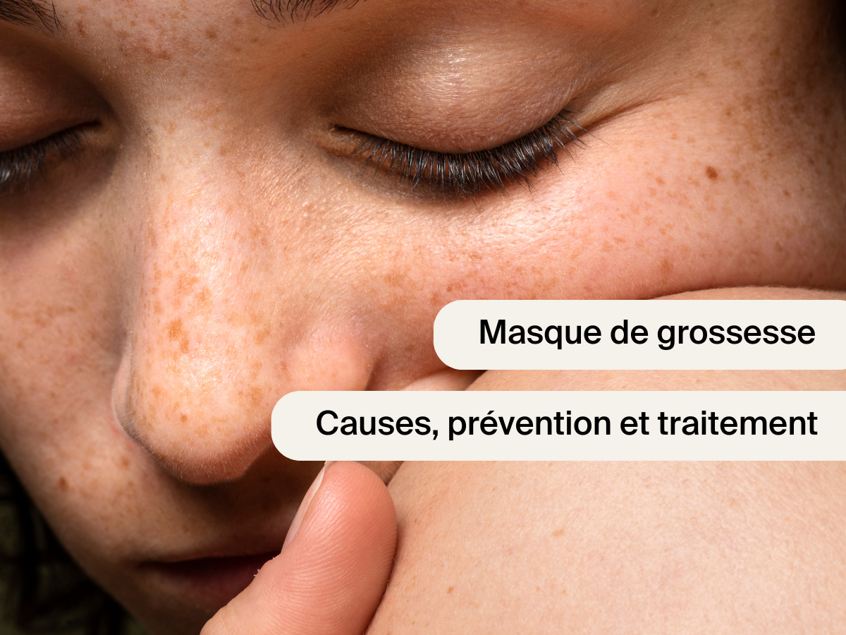 Masque de grossesse visage : causes, prévention et solutions